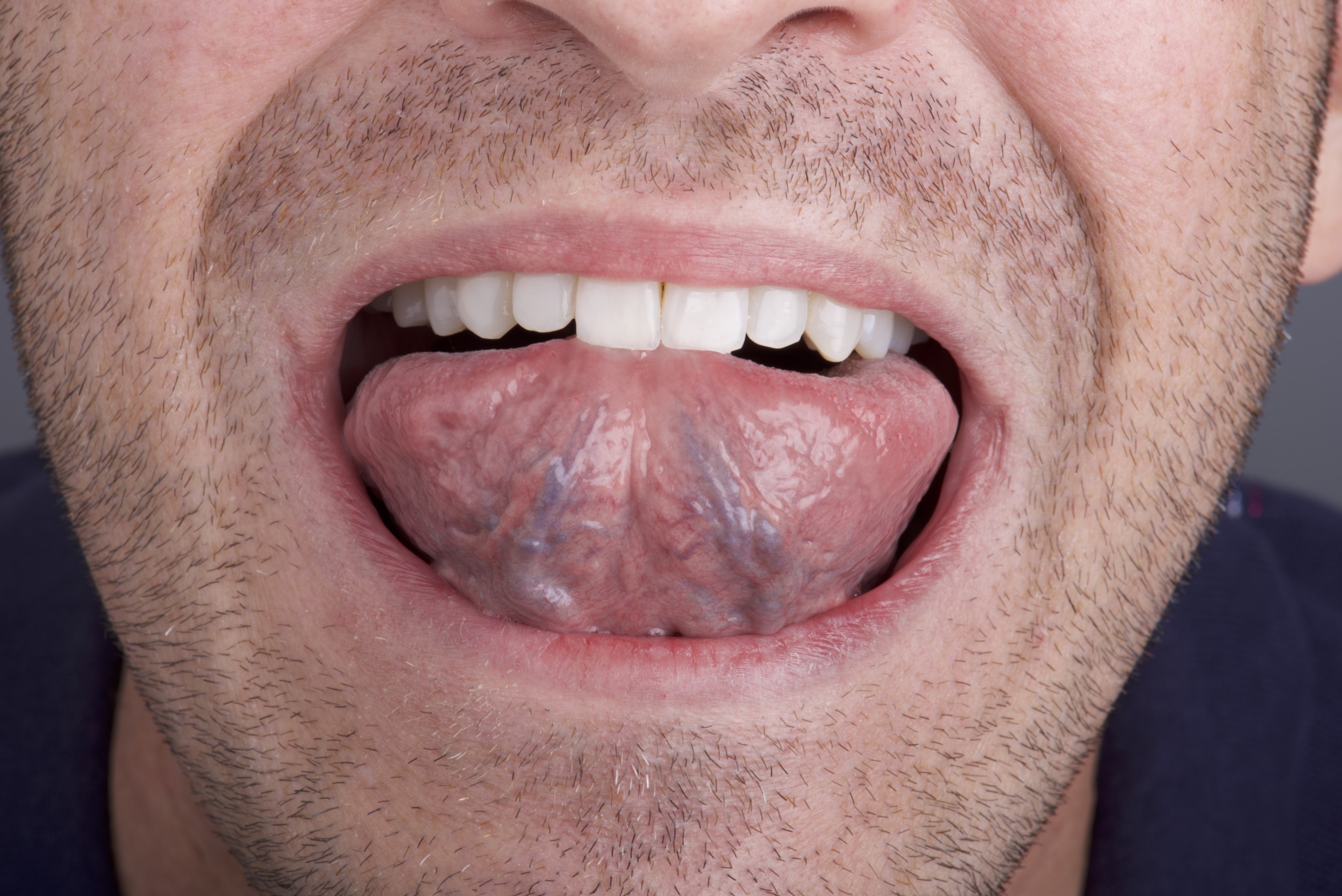 Undersurface Of Tongue 2 